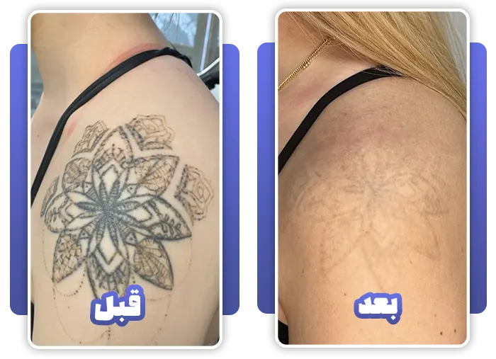 laser-tattoo-15